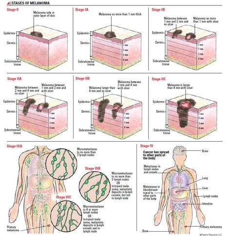 melanoma stages